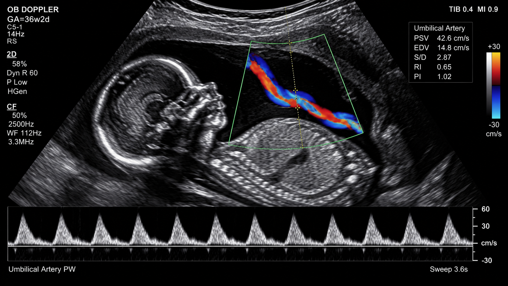 Pregnancy Doppler scan