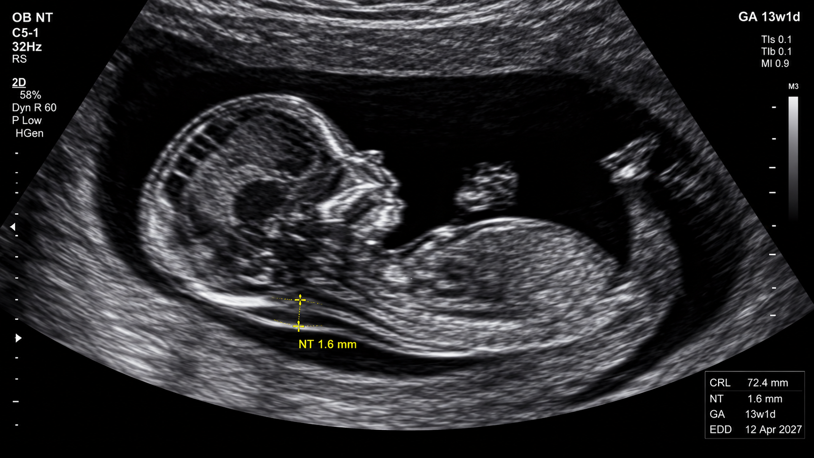 Nuchal translucency ultrasound scan