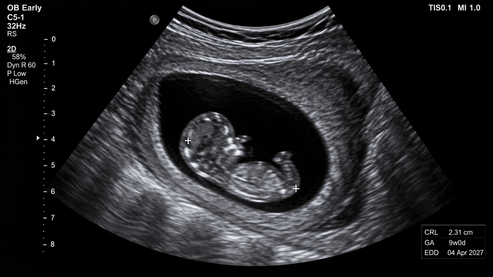 Early pregnancy viability scan
